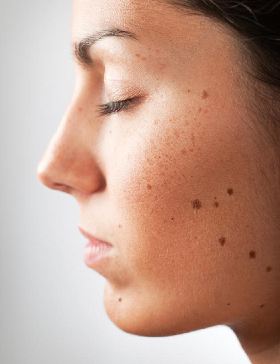 como eliminar la melanina de la piel como eliminar la melanina de la piel